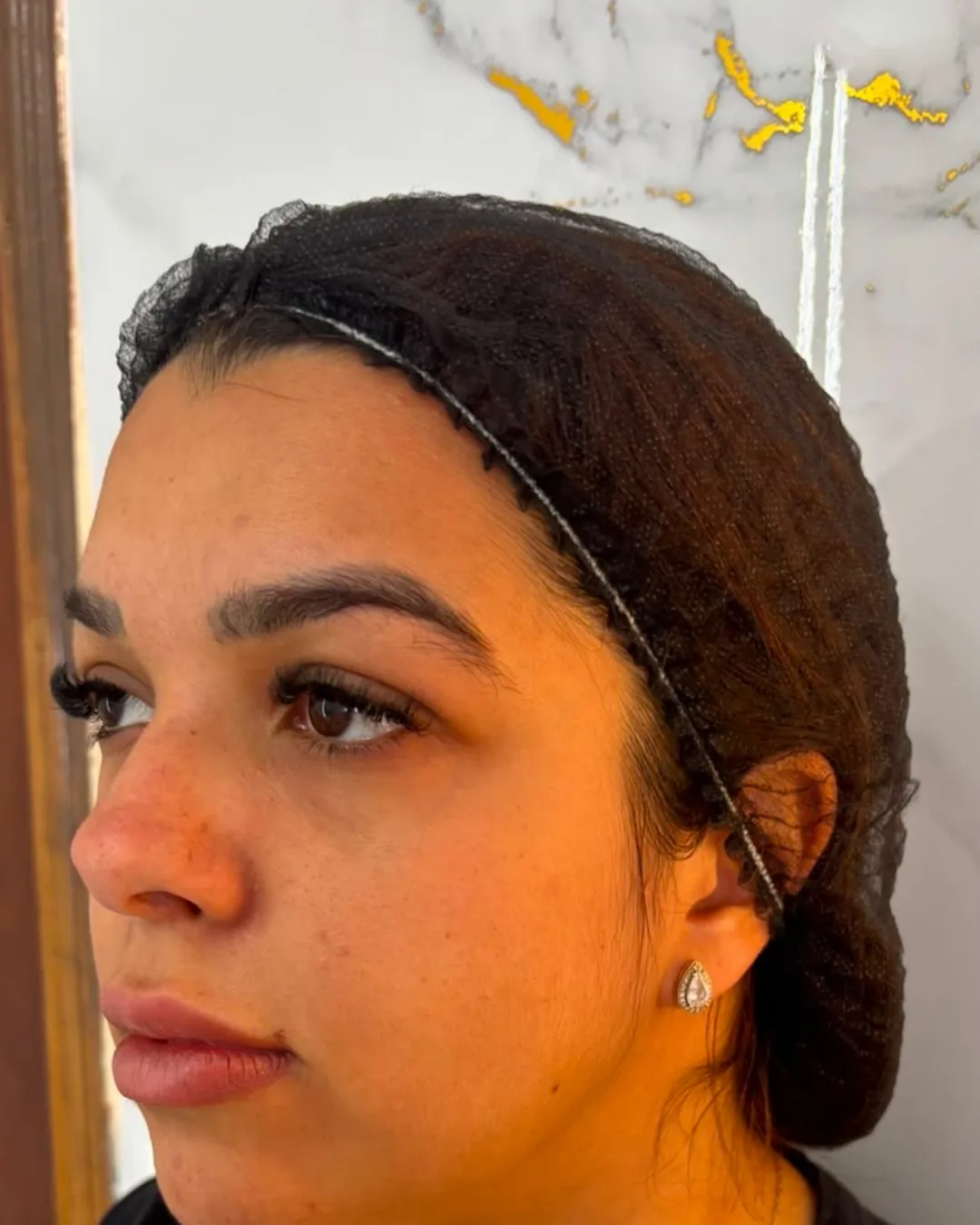 Antes: paciente de três quartos, antes da harmonização facial