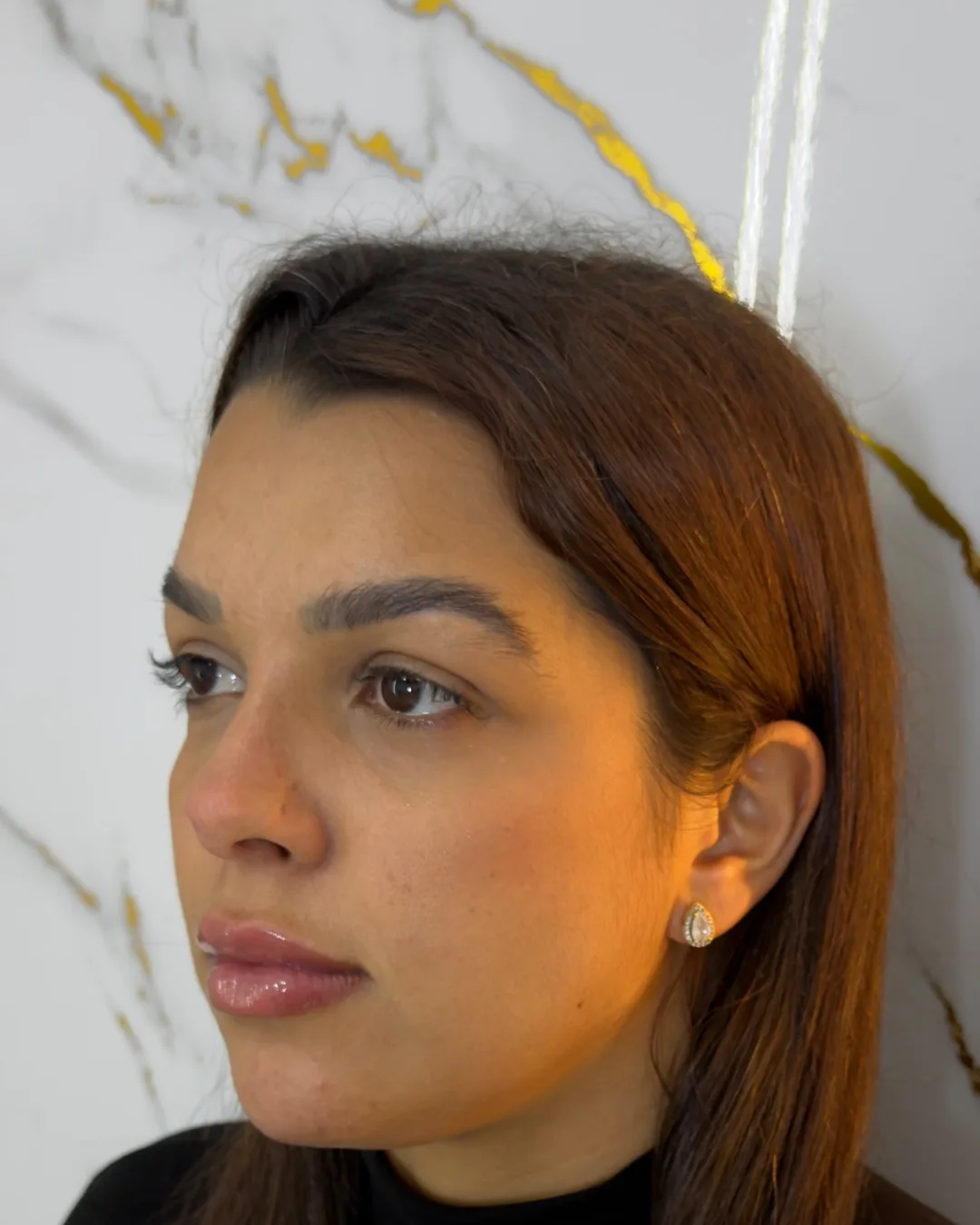 Depois: a mesma paciente, após a harmonização facial