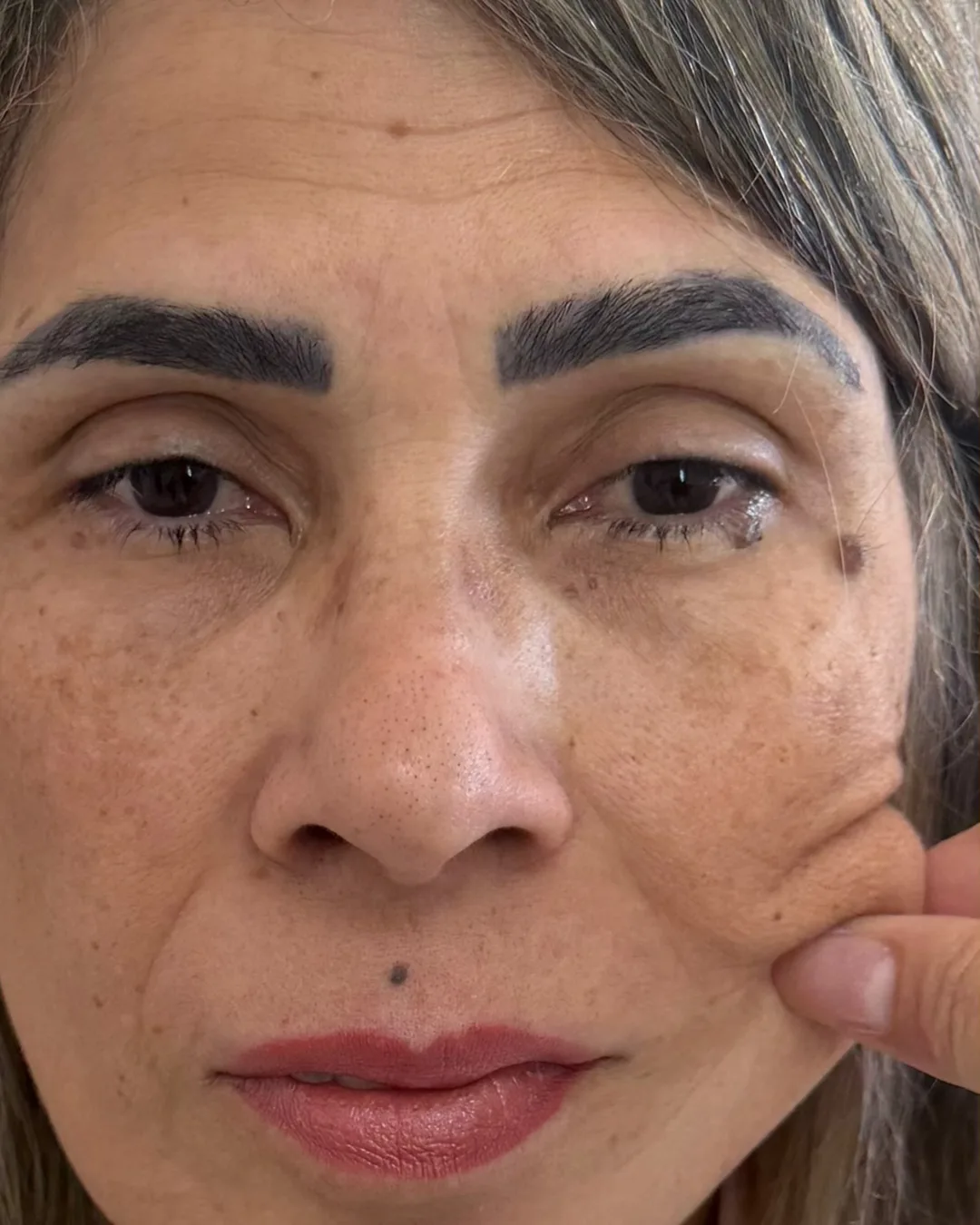 Antes: rosto de frente, antes do bioestimulador