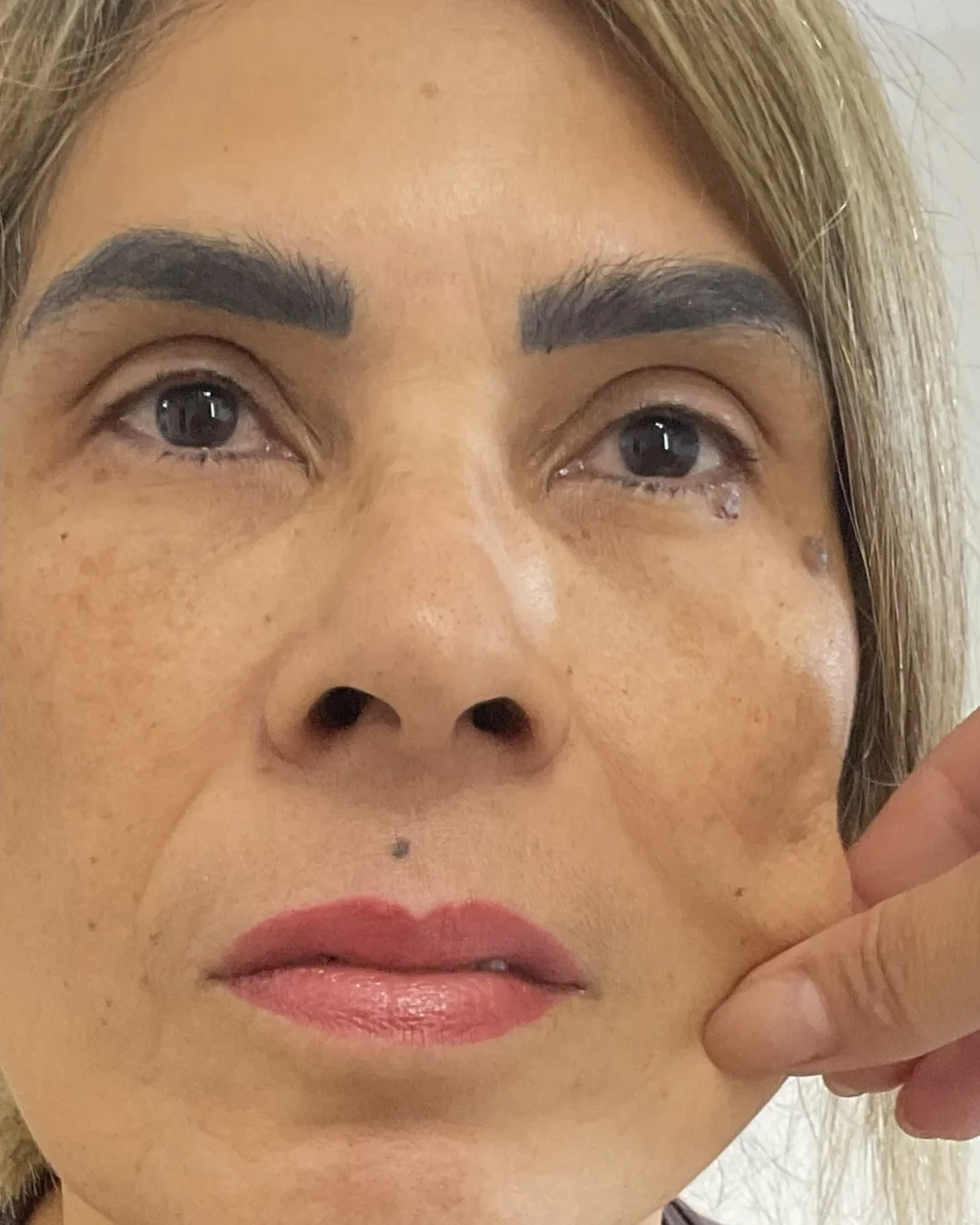 Depois: o mesmo rosto, após uma sessão de bioestimulador