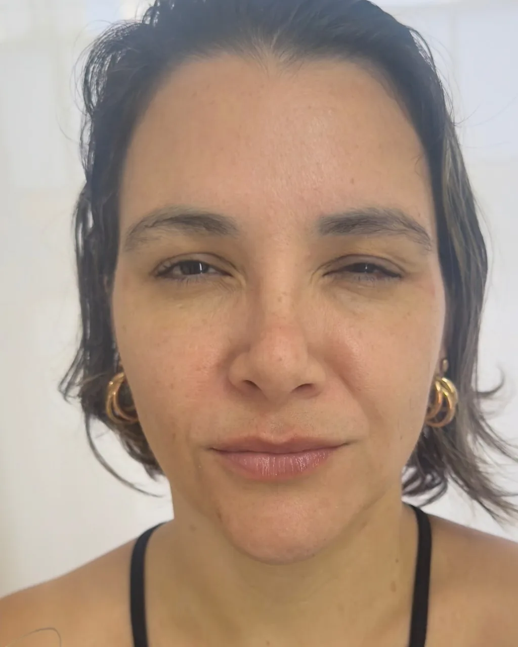 Depois: o mesmo rosto, com as marcas suavizadas após a toxina botulínica